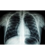 An X-ray of a chest